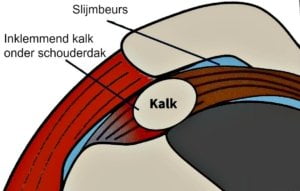 tendinose schouder