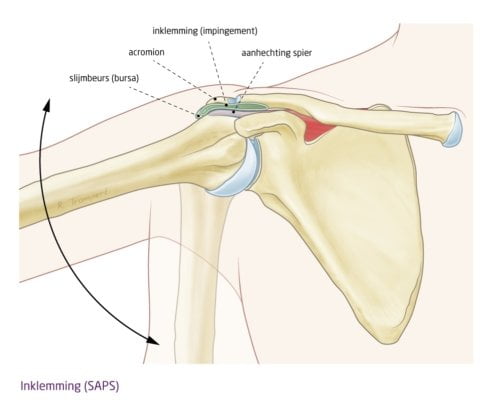 slijmbeursontsteking schouder