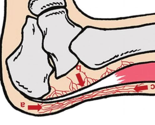 Neovascularisatie