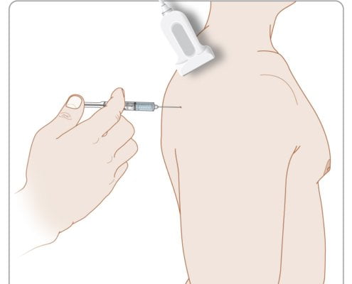 injectie-frozen-shoulder