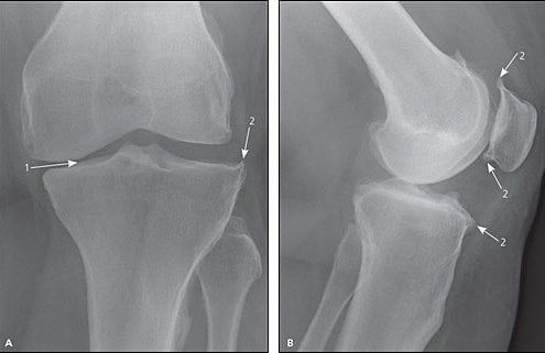 knie-artrose-röntgenonderzoek