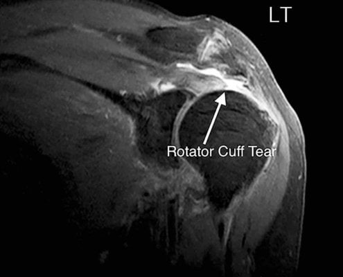 cuff ruptuur MRI