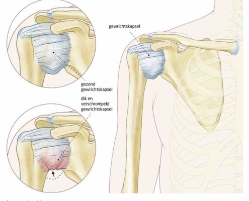 Frozen Shoulder Behandeling – Voor Snel Minder Pijn – Echozorg