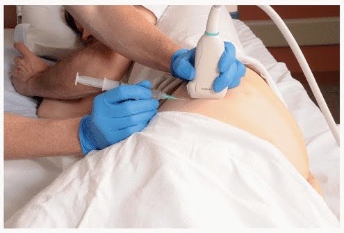 Echogeleide injectie slijmbeursontsteking van de heup