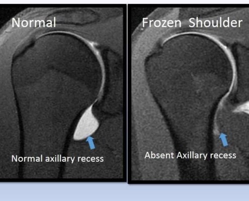 Frozen shoulder MRI