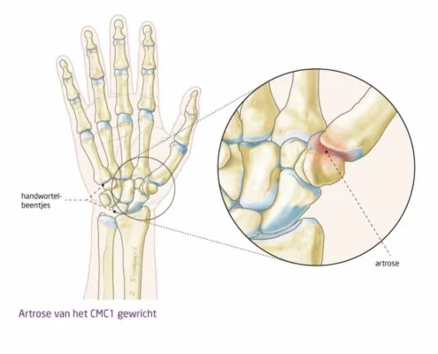 Vaag Effectief Aap Artrose duim – Voor snel minder Pijn – Kies Echozorg