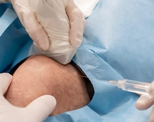 echogeleide hyaluronzuur injectie